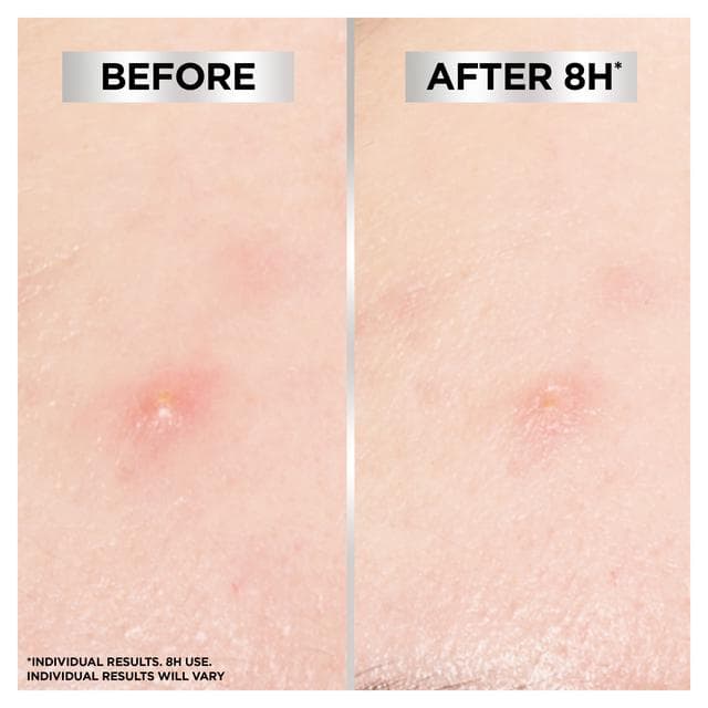 Garnier 8 Hour Invisible Blemish Patches for Spots x22 - gallery image 5